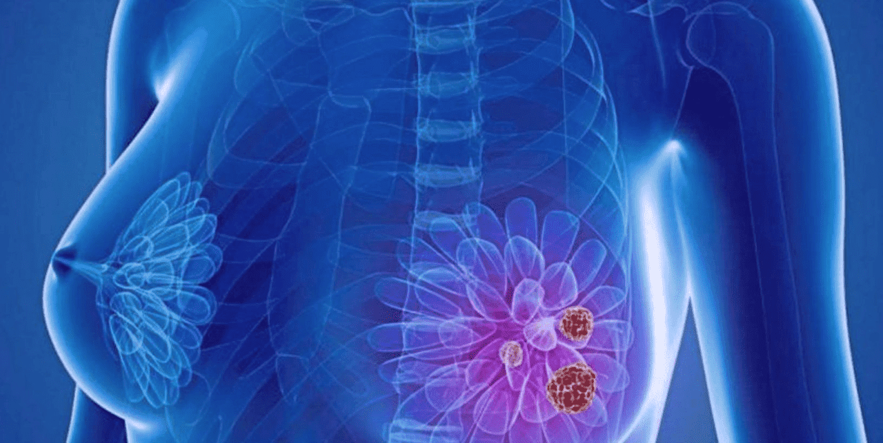 Ранняя диагностика рака груди важность профилактических осмотров